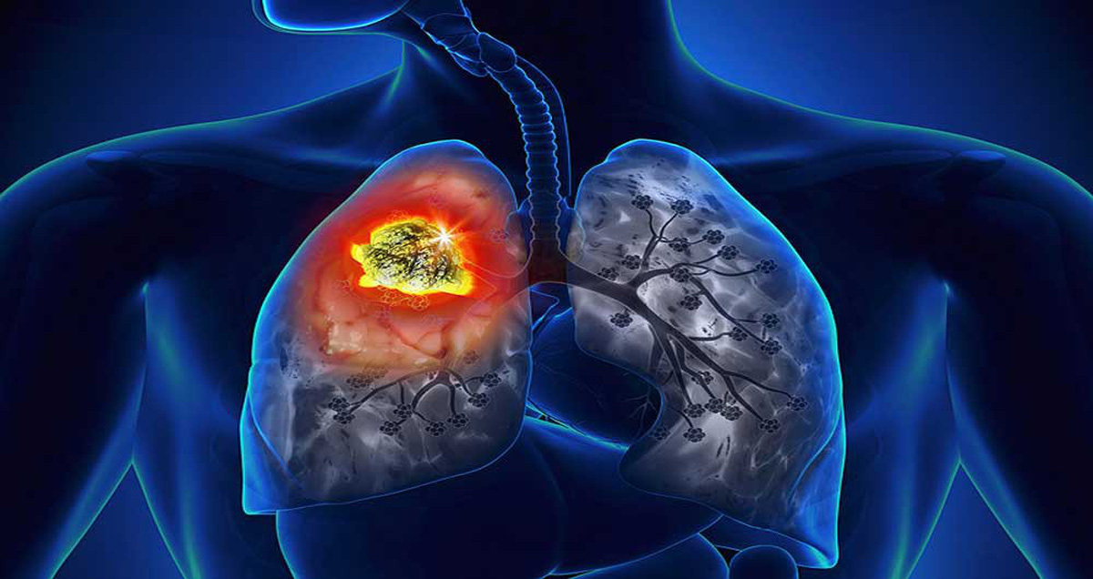 Bệnh Bụi phổi: Nguyên nhân, biến chứng và cách điều trị
